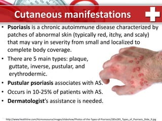 ProPowerPoint.Ru
• Psoriasis is a chronic autoimmune disease characterized by
patches of abnormal skin (typically red, itchy, and scaly)
that may vary in severity from small and localized to
complete body coverage.
• There are 5 main types: plaque,
guttate, inverse, pustular, and
erythrodermic.
• Pustular psoriasis associates with AS.
• Occurs in 10-25% of patients with AS.
• Dermatologist’s assistance is needed.
Cutaneous manifestations
http://www.healthline.com/hlcmsresource/images/slideshow/Photos-of-the-Types-of-Psoriasis/285x285_Types_of_Psoriasis_Slide_9.jpg
 