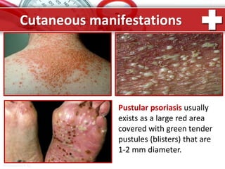 ProPowerPoint.Ru
Cutaneous manifestations
Pustular psoriasis usually
exists as a large red area
covered with green tender
pustules (blisters) that are
1-2 mm diameter.
 