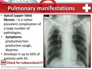ProPowerPoint.Ru
Pulmonary manifestations
• Apical (upper lobe)
fibrosis – is a rather
prevalent complication of
a large number of
pathologies.
• Symptoms:
productive/non-
productive cough,
dyspnea.
• Develops in up to 50% of
patients with AS.
Check for tuberculosis!!!
http://2.bp.blogspot.com/_WnNkrYwZkW8/Sub3XSt0GwI/AAAAAAAACiM/LwScCtQkFlY/s1
600-h/fibrosis2.JPG
 