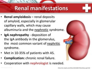 ProPowerPoint.Ru
Renal manifestations
• Renal amyloidosis – renal deposits
of amyloid, especially in glomerular
capillary walls, which may cause
albuminuria and the nephrotic syndrome.
• IgA nephropathy - deposition of
the IgA antibody in the glomerulus,
the most common variant of nephritic
syndrome.
• Met in 10-35% of patients with AS.
• Complication: chronic renal failure.
• Cooperation with nephrologist is needed.
hhttp://cdn.shopify.com/s/files/1/0316/8657/files/Kidney.png?1418
 