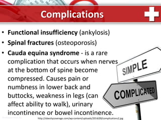 ProPowerPoint.Ru
Complications
• Functional insufficiency (ankylosis)
• Spinal fractures (osteoporosis)
• Cauda equina syndrome - is a rare
complication that occurs when nerves
at the bottom of spine become
compressed. Causes pain or
numbness in lower back and
buttocks, weakness in legs (can
affect ability to walk), urinary
incontinence or bowel incontinence.
http://obesitycoverage.com/wp-content/uploads/2014/09/complications2.jpg
 