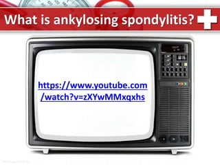 ProPowerPoint.Ru
What is ankylosing spondylitis?
https://www.youtube.com
/watch?v=zXYwMMxqxhs
 