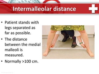 ProPowerPoint.Ru
Intermalleolar distance
• Patient stands with
legs separated as
far as possible.
• The distance
between the medial
malleoli is
measured.
• Normally >100 cm.
 