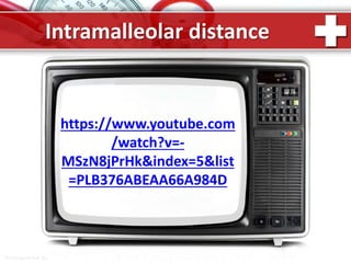 ProPowerPoint.Ru
Intramalleolar distance
https://www.youtube.com
/watch?v=-
MSzN8jPrHk&index=5&list
=PLB376ABEAA66A984D
 