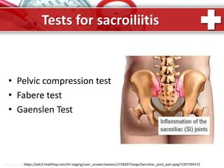 ProPowerPoint.Ru
Tests for sacroiliitis
• Pelvic compression test
• Fabere test
• Gaenslen Test
https://edc2.healthtap.com/ht-staging/user_answer/avatars/1728307/large/Sacroiliac_joint_pain.jpeg?1397394172
 