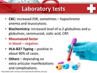 ProPowerPoint.Ru
Laboratory tests
• CBC: increased ESR, sometimes – hypochromic
anemia and leucocytosis.
• Biochemistry: increased level of α-2-globulines and γ-
globulines, seromucoid, sialic acid, CRP.
• Rheumatoid factor
in blood – negative.
• HLA-B27 Typing – positive in
about 90% of cases.
• Others – depending on
extra articular manifestations
and complications.
http://www.cryohc.com/wp-content/uploads/2013/04/lab_tests.png
 