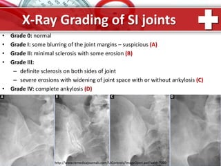 ProPowerPoint.Ru
X-Ray Grading of SI joints
• Grade 0: normal
• Grade I: some blurring of the joint margins – suspicious (A)
• Grade II: minimal sclerosis with some erosion (B)
• Grade III:
– definite sclerosis on both sides of joint
– severe erosions with widening of joint space with or without ankylosis (C)
• Grade IV: complete ankylosis (D)
http://www.remedicajournals.com/UIControls/ImageOpen.axd?aaid=7000
 