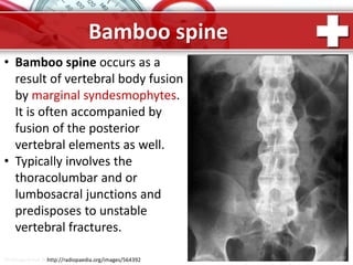 ProPowerPoint.Ru
Bamboo spine
• Bamboo spine occurs as a
result of vertebral body fusion
by marginal syndesmophytes.
It is often accompanied by
fusion of the posterior
vertebral elements as well.
• Typically involves the
thoracolumbar and or
lumbosacral junctions and
predisposes to unstable
vertebral fractures.
http://radiopaedia.org/images/564392
 