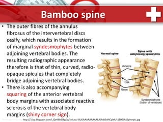 ProPowerPoint.Ru
Bamboo spine
• The outer fibres of the annulus
fibrosus of the intervertebral discs
ossify, which results in the formation
of marginal syndesmophytes between
adjoining vertebral bodies. The
resulting radiographic appearance
therefore is that of thin, curved, radio-
opaque spicules that completely
bridge adjoining vertebral bodies.
• There is also accompanying
squaring of the anterior vertebral
body margins with associated reactive
sclerosis of the vertebral body
margins (shiny corner sign).
http://1.bp.blogspot.com/_QeK6h6J8gEo/SxILouJ-0UI/AAAAAAAAAEA/hdt3AhCyJek/s1600/ASSpinepic.jpg
 