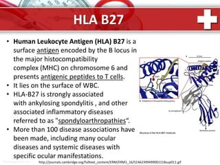ProPowerPoint.Ru
HLA B27
http://journals.cambridge.org/fulltext_content/ERM/ERM1_16/S1462399499001118sup011.gif
• Human Leukocyte Antigen (HLA) B27 is a
surface antigen encoded by the B locus in
the major histocompatibility
complex (MHC) on chromosome 6 and
presents antigenic peptides to T cells.
• It lies on the surface of WBC.
• HLA-B27 is strongly associated
with ankylosing spondylitis , and other
associated inflammatory diseases
referred to as "spondyloarthropathies“.
• More than 100 disease associations have
been made, including many ocular
diseases and systemic diseases with
specific ocular manifestations.
 