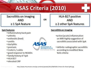 ProPowerPoint.Ru
ASAS Criteria (2010)
http://www.rheumtutor.com/wp-content/uploads/2012/08/ASAS-Criteria-for-Axial-SpA6.jpg
 