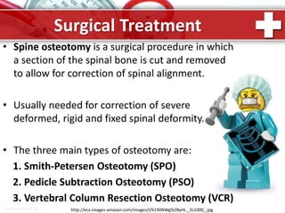 ProPowerPoint.Ru
Surgical Treatment
• Spine osteotomy is a surgical procedure in which
a section of the spinal bone is cut and removed
to allow for correction of spinal alignment.
• Usually needed for correction of severe
deformed, rigid and fixed spinal deformity.
• The three main types of osteotomy are:
1. Smith-Petersen Osteotomy (SPO)
2. Pedicle Subtraction Osteotomy (PSO)
3. Vertebral Column Resection Osteotomy (VCR)
http://ecx.images-amazon.com/images/I/6190NWg%2ByHL._SL1000_.jpg
 