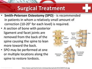 ProPowerPoint.Ru
Surgical Treatment
• Smith-Petersen Osteotomy (SPO) - is recommended
in patients in whom a relatively small amount of
correction (10-20° for each level) is required.
• A section of bone with posterior
ligament and facet joints are
removed from the back of the
spine causing the spine to lean
more toward the back.
• SPO may be performed at one
or multiple locations along the
spine to restore lordosis.
https://www.superteachertools.net/jeopardyx/uploads/20141009/Ponte.jpg
 