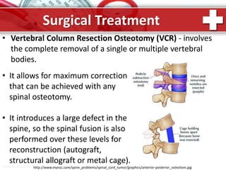 ProPowerPoint.Ru
Surgical Treatment
• Vertebral Column Resection Osteotomy (VCR) - involves
the complete removal of a single or multiple vertebral
bodies.
• It allows for maximum correction
that can be achieved with any
spinal osteotomy.
• It introduces a large defect in the
spine, so the spinal fusion is also
performed over these levels for
reconstruction (autograft,
structural allograft or metal cage).
http://www.myissc.com/spine_problems/spinal_cord_tumor/graphics/anterior-posterior_osteotom.jpg
 