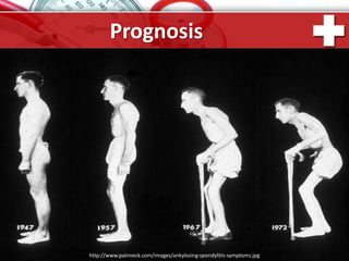 ProPowerPoint.Ru
Prognosis
http://www.painneck.com/images/ankylosing-spondylitis-symptoms.jpg
 