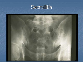 Sacroilitis
 