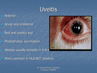 Uveitis
 Anterior
 Acute and unilateral
 Red and painful eye
 Photophobia, lacrimation
 Attacks usually subside in 4-8 weeks
 More common in HLA-B27 positive
Dr Gurjant Singh, Assistant
Professor, MMIPR
 
