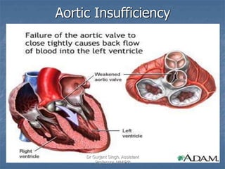 Aortic Insufficiency
Dr Gurjant Singh, Assistant
Professor, MMIPR
 