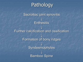 Pathology
Sacroiliac joint synovitis
↓
Enthesitis
↓
Further calcification and ossification
↓
Formation of bony ridges
↓
Syndesmophytes
↓
Bamboo Spine
 