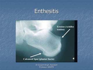 Enthesitis
Calcaneal Spur (plantar fascia)
Erosion (Achilles
tendon)
Dr Gurjant Singh, Assistant
Professor, MMIPR
 