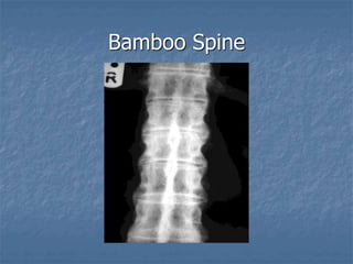Bamboo Spine
 
