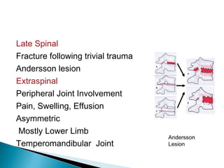 Late Spinal
Fracture following trivial trauma
Andersson lesion
Extraspinal
Peripheral Joint Involvement
Pain, Swelling, Effusion
Asymmetric
Mostly Lower Limb
Temperomandibular Joint
Andersson
Lesion
 