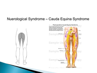 Nuerological Syndrome – Cauda Equina Syndrome
 