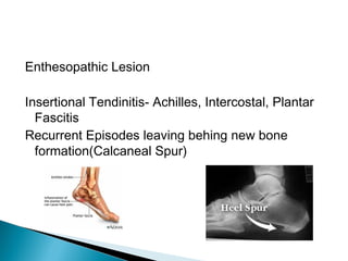 Enthesopathic Lesion
Insertional Tendinitis- Achilles, Intercostal, Plantar
Fascitis
Recurrent Episodes leaving behing new bone
formation(Calcaneal Spur)
 