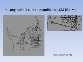 • Longitud del cuerpo mandibular LCM (Go-Me)
Norma : ( 71mm (+/-5)
 