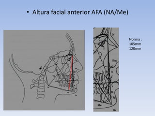 • Altura facial anterior AFA (NA/Me)
Norma :
105mm
120mm
 
