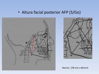 • Altura facial posterior AFP (S/Go)
Norma : (78 mm a 85mm)
 