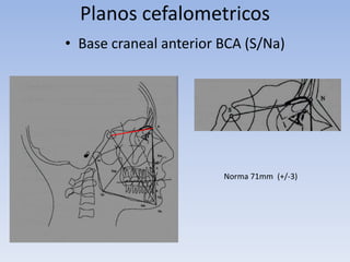 Planos cefalometricos
• Base craneal anterior BCA (S/Na)
Norma 71mm (+/-3)
 
