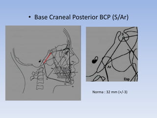 • Base Craneal Posterior BCP (S/Ar)
Norma : 32 mm (+/-3)
 