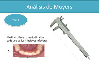 PPAasSoO 1 1 
Medir el diámetro mesiodistal de 
cada uno de los 4 incisivos inferiores. 
SI 
 
