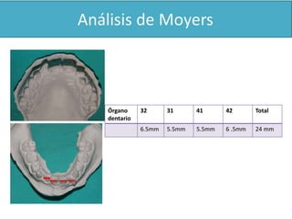 Órgano 
dentario 
32 31 41 42 Total 
6.5mm 5.5mm 5.5mm 6 .5mm 24 mm 
 