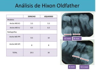 DERECHO IZQUIERDO 
Modelos 
Ancho MD ICI 5.5 5.5 
Ancho MD ILI 6.5 6.5 
Radiografías 
Ancho MD PPI 
9.5 10 
Ancho MD SPI 
8 8 
TOTAL 29.5 30 
10 mm 8 mm 
8 mm 9.5 mm 
 