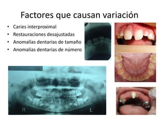 Factores que causan variación 
• Caries interproximal 
• Restauraciones desajustadas 
• Anomalías dentarias de tamaño 
• Anomalías dentarias de número 
 