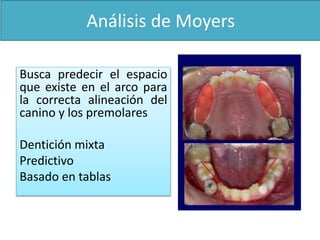 Análisis de Moyers 
Busca predecir el espacio 
que existe en el arco para 
la correcta alineación del 
canino y los premolares 
Dentición mixta 
Predictivo 
Basado en tablas 
 