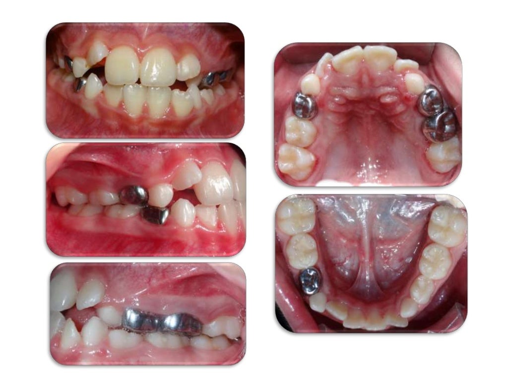 Análisis de modelos en dentición mixta