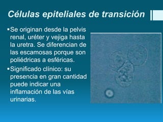 Células epiteliales de transición
Se originan desde la pelvis
renal, uréter y vejiga hasta
la uretra. Se diferencian de
las escamosas porque son
poliédricas a esféricas.
Significado clínico: su
presencia en gran cantidad
puede indicar una
inflamación de las vías
urinarias.

 