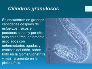 Cilindros granulosos
Se encuentran en grandes
cantidades después de
esfuerzos físicos en
personas sanas y por otro
lado están frecuentemente
asociados con
enfermedades agudas y
crónicas del riñón, sobre
todo en la glomerulonefritis
y más raramente en la
pielonefritis.

 