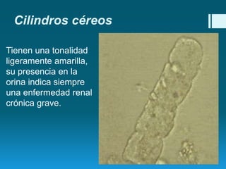 Cilindros céreos
Tienen una tonalidad
ligeramente amarilla,
su presencia en la
orina indica siempre
una enfermedad renal
crónica grave.

 