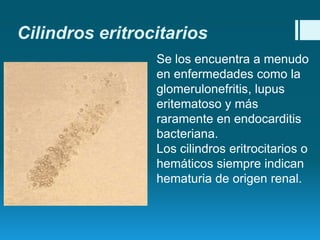 Cilindros eritrocitarios
Se los encuentra a menudo
en enfermedades como la
glomerulonefritis, lupus
eritematoso y más
raramente en endocarditis
bacteriana.
Los cilindros eritrocitarios o
hemáticos siempre indican
hematuria de origen renal.

 