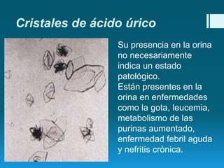 Cristales de ácido úrico
Su presencia en la orina
no necesariamente
indica un estado
patológico.
Están presentes en la
orina en enfermedades
como la gota, leucemia,
metabolismo de las
purinas aumentado,
enfermedad febril aguda
y nefritis crónica.

 