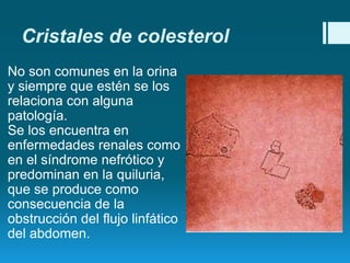 Cristales de colesterol
No son comunes en la orina
y siempre que estén se los
relaciona con alguna
patología.
Se los encuentra en
enfermedades renales como
en el síndrome nefrótico y
predominan en la quiluria,
que se produce como
consecuencia de la
obstrucción del flujo linfático
del abdomen.

 