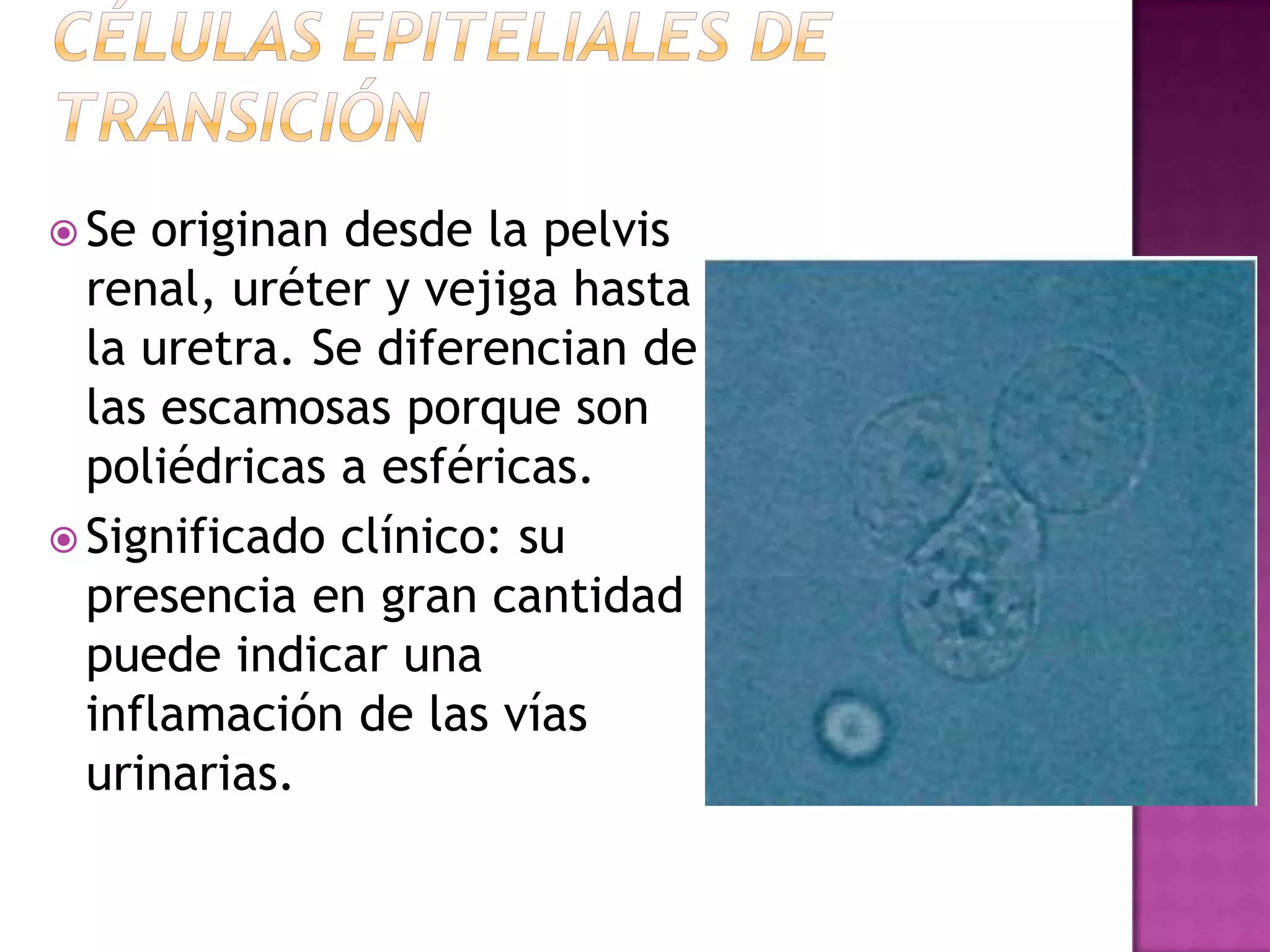  Se

originan desde la pelvis
renal, uréter y vejiga hasta
la uretra. Se diferencian de
las escamosas porque son
poliédricas a esféricas.
 Significado clínico: su
presencia en gran cantidad
puede indicar una
inflamación de las vías
urinarias.

 