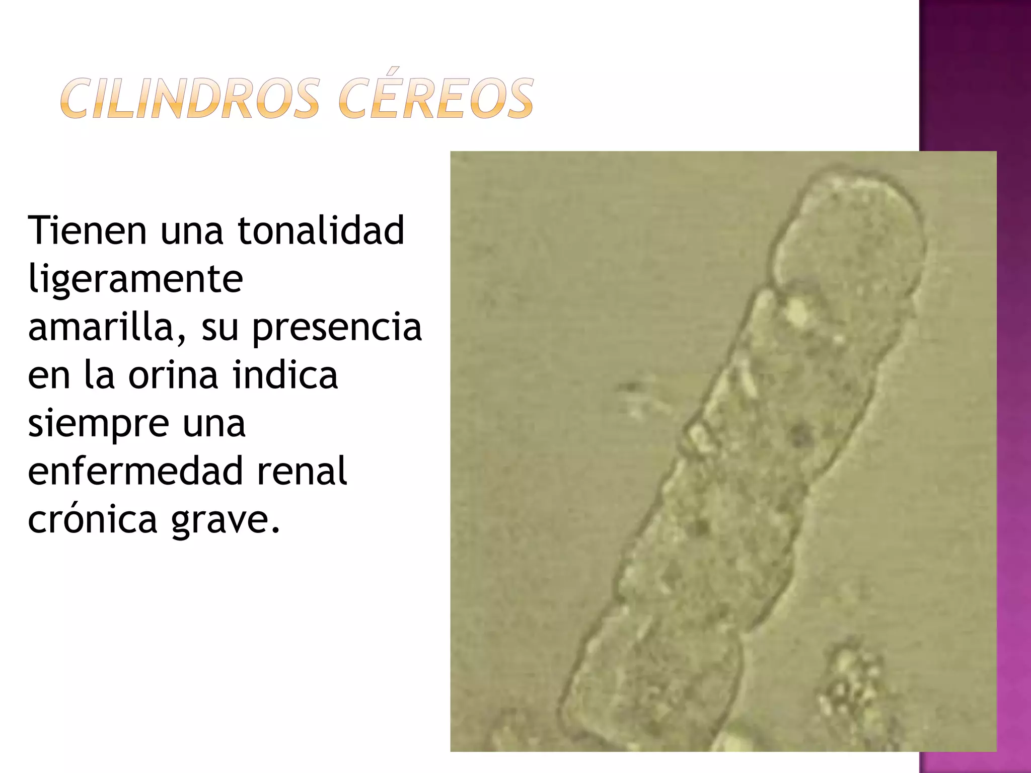 Tienen una tonalidad
ligeramente
amarilla, su presencia
en la orina indica
siempre una
enfermedad renal
crónica grave.

 