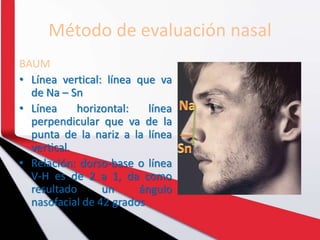 Método de evaluación nasal
BAUM
• Línea vertical: línea que va
de Na – Sn
• Línea horizontal: línea
perpendicular que va de la
punta de la nariz a la línea
vertical.
• Relación: dorso-base o línea
V-H es de 2 a 1, da como
resultado un ángulo
nasofacial de 42 grados
 