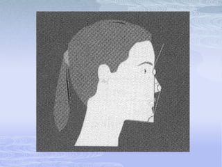 Línea estética de RickettsPunta de la nariz hasta pogonion cutáneo.