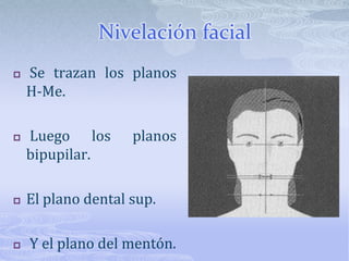 Nivelación facial Se trazan los planos H-Me.  Luego los planos bipupilar. El plano dental sup. Y el plano del mentón. 